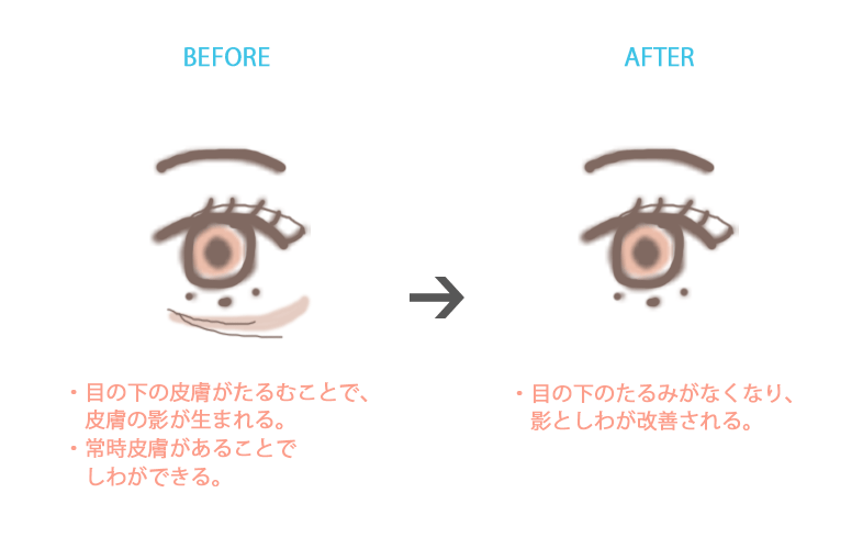 「目の下のたるみ」へウルセラを行った場合に期待できる効果